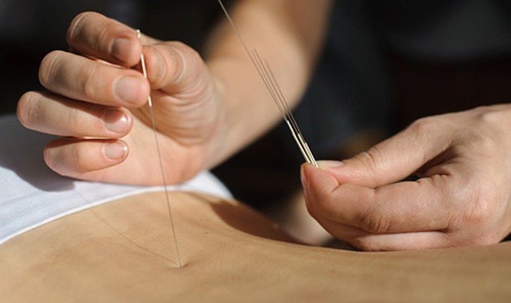 Les aiguilles d'acupuncture